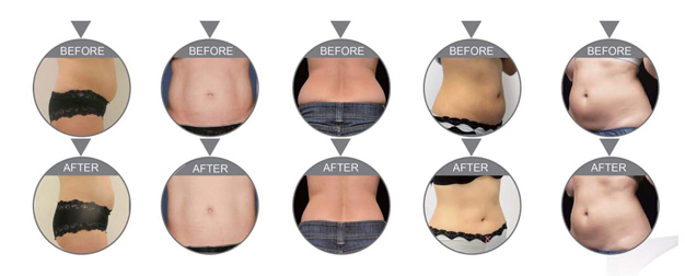 RF CAVITATION 2