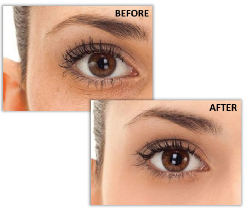 before after eyes